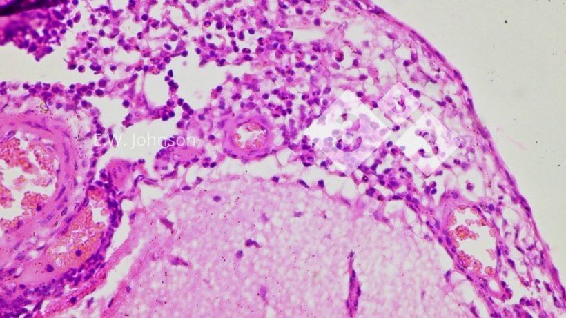 Imagen 3. Meningitis con células mononucleares y algunas células polimorfonucleares. Cerebro.